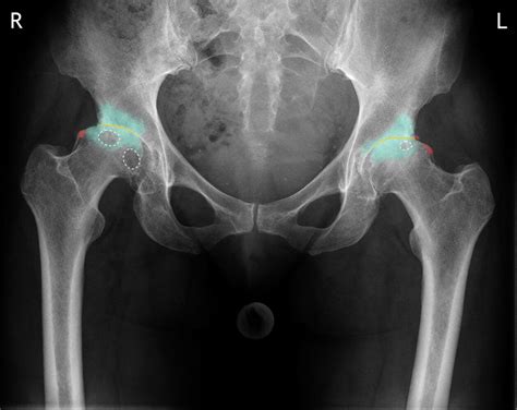 Osteoarthritis Hip X Ray Findings