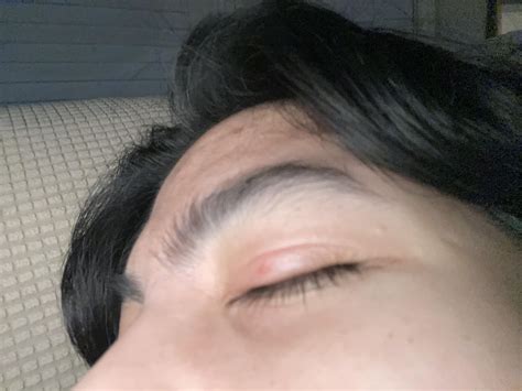 Swollen eyelid after picking milia : r/DermatologyQuestions