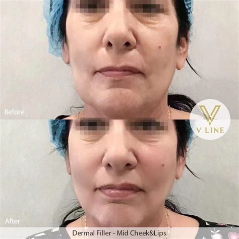 dermal fillers      cosmetic center