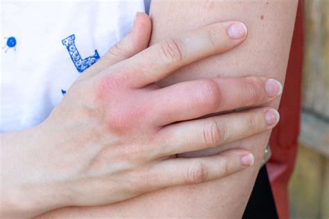 Causes and Treatment of Swollen Finger Joints