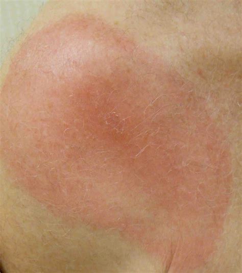 Lyme Disease Test Humans at Rita Block blog