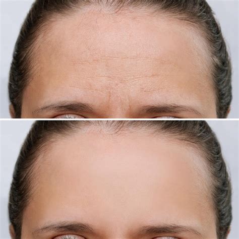 Premium Photo | Young woman with wrinkles on a forehead before and ...