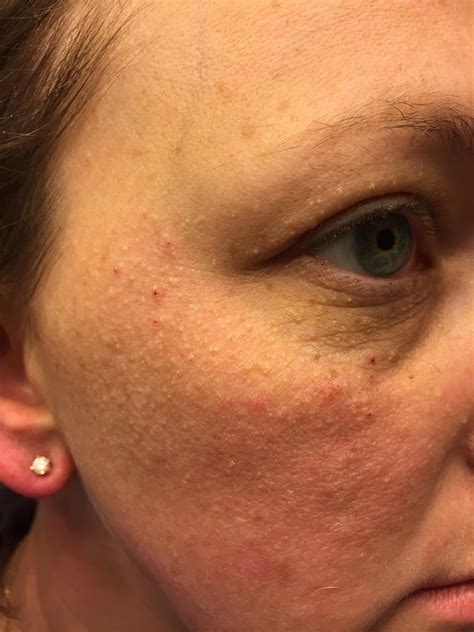 Calcium Deposits On Face Types Of Acne Scars: Pictures Of Boxcar,