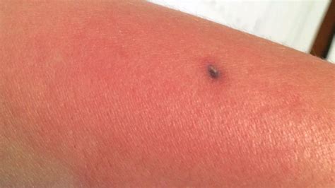 Juvenile Brown Recluse Bite