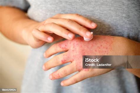 woman applying ointment  moisturizing cream   eczema atopic
