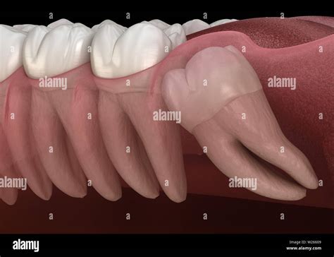 Mesial hi-res stock photography and images - Alamy