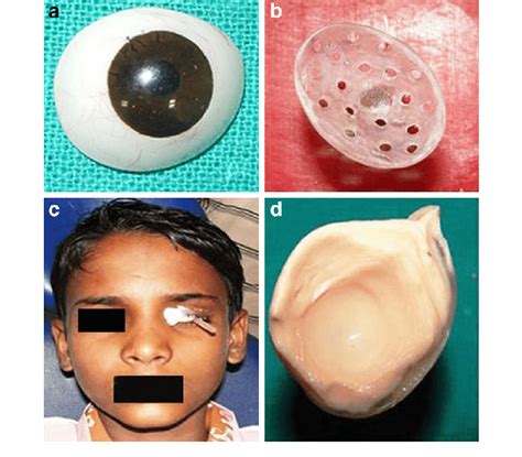 Impression procedure for ocular prosthesis | Download Scientific Diagram