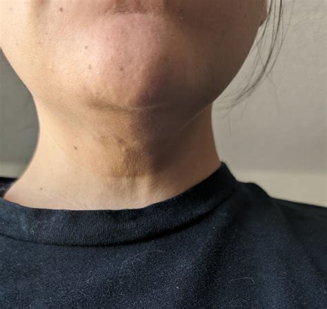 Sagging Neck Skin After Weight Loss: Effective Solutions Revealed