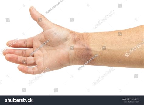 hot water burn  skin hand stock photo  shutterstock