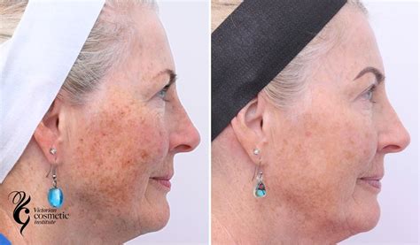 IPL Skin Rejuvenation | Victorian Cosmetic Institute