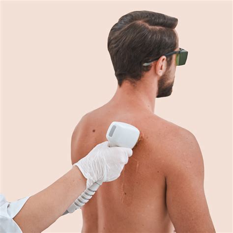 laser hair removal for men face 10