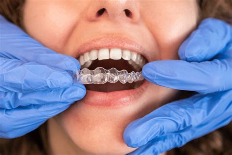 What is Hypodontia? Causes, Syndromes & Treatments