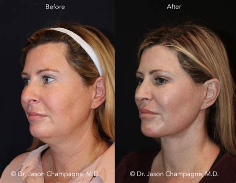 Advanced Radio Frequency Skin Tightening Gallery | Beverly Hills Plastic Surgeon - Dr. Jason ...