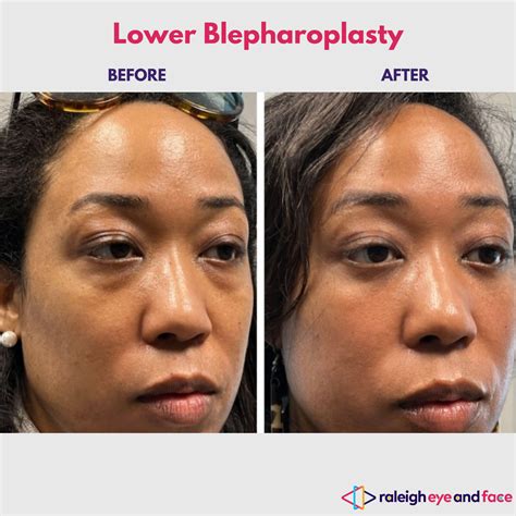 Top Rated Lower Eyelid Surgery Before And After Gallery — Raleigh Eye