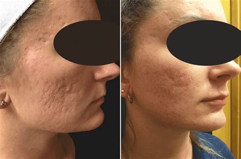 NonSurgical Approach to Deep Acne Scars with RF Microneedling, and ...