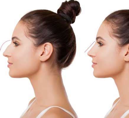 Rhinoplasty Surgery Doctors in Bhubaneswar | Nose Reshaping Clinic