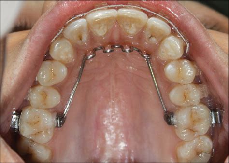 Tongue Cribs, What Are They and What Do They Do? - Blogs - WebDental, LLC