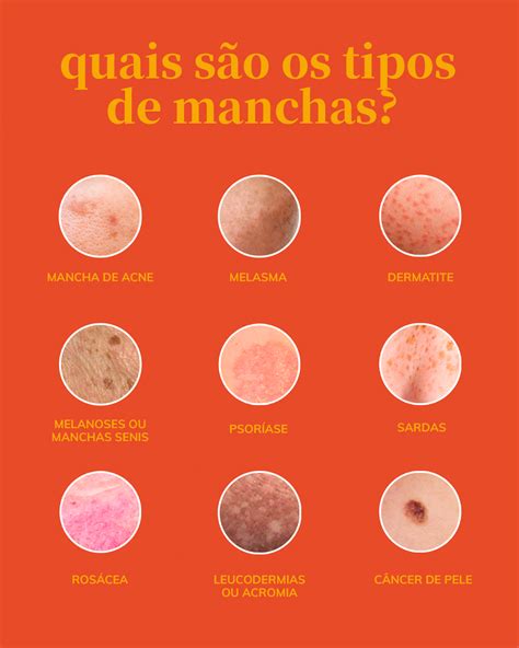 Dermatite Nervosa Alergia Emocional Sintomas De Estresse Na Pele