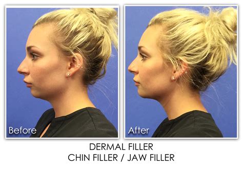 filler   face archives skin rejuvenation clinic skin