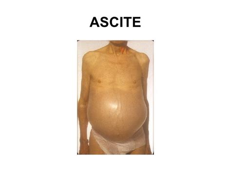 O Que Significa Ascite - Ascite
