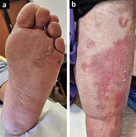 First case of Multiple Self-Healing Palmoplantar Carcinoma Associated