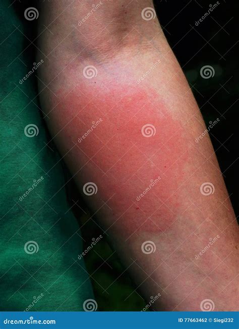 Wasp sting stock photo. Image of allergy, woman, bite - 77663462