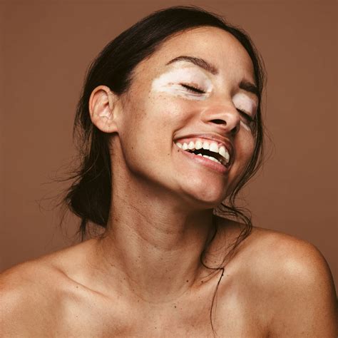 What Is Vitiligo? A Dermatologist Explains the Skin Condition