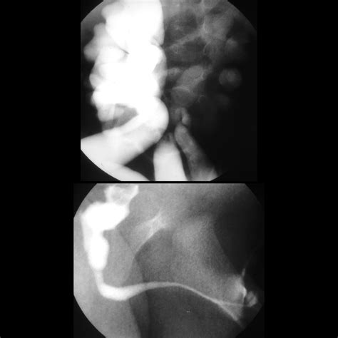 Posterior Urethral Valves | Pediatric Radiology Reference Article
