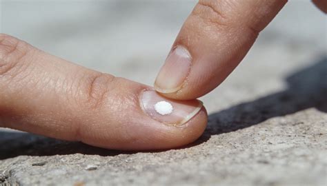 Ponto Branco Na Unha - Roer a unha e manicure agressiva causam microtraumas que viram manchas ...