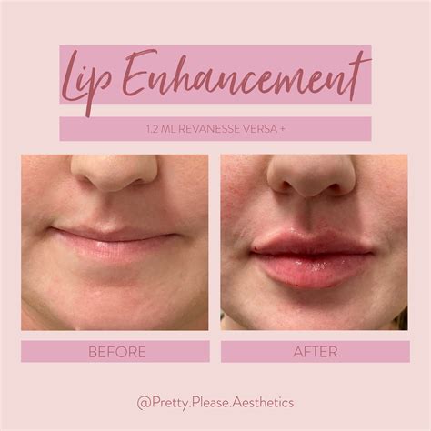 1 syringe lip filler before and after – Artofit