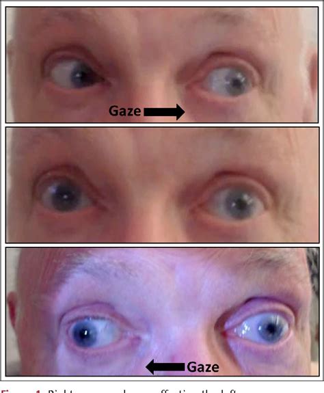 Figure 1 from Isolated Medial Rectus Nuclear Palsy as a Rare ...