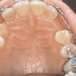 impacted canines traverse city mi