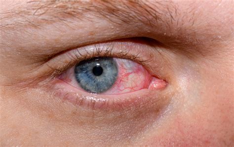 dry eye  latest thinking  dry eye treatments harvard health