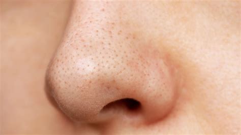 regulate sebaceous filaments   nose