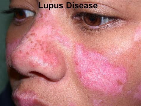 lupus disease signs  symptoms diagnosis  treatment health