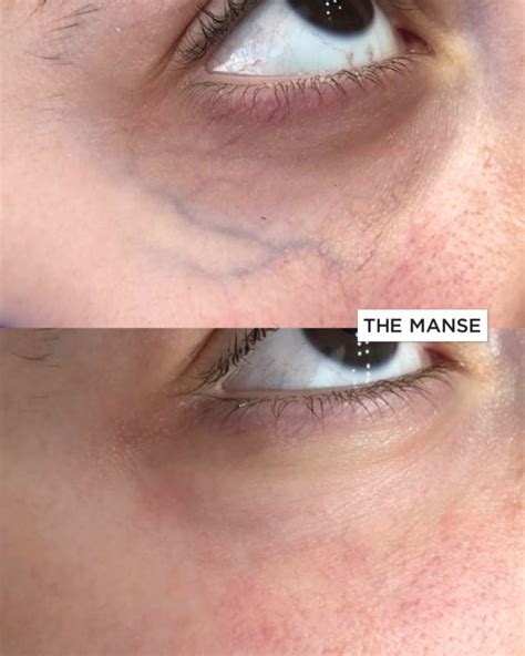 Blue Vein Removal - Best Clinic for Facial Vein Removal Sydney