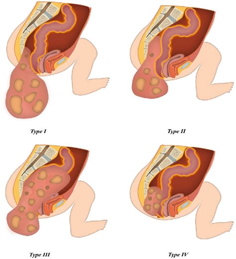 Information Sacrococcygeal Teratoma Types Guide
