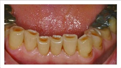 Dental attrition – Dr. Ljubica Banić