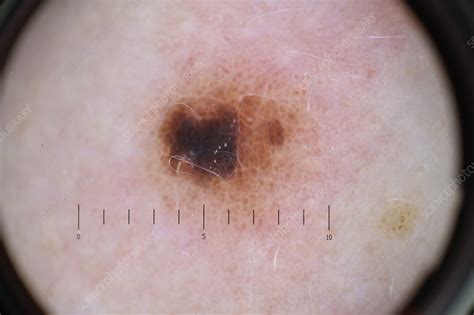 mole dermatoscope image stock image  science photo library