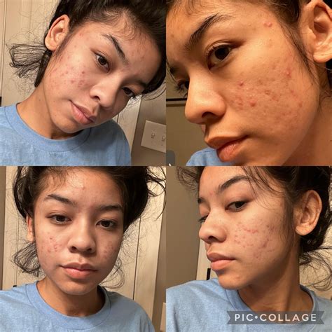 [ACNE] does acne come back after doxycycline? : r/SkincareAddiction