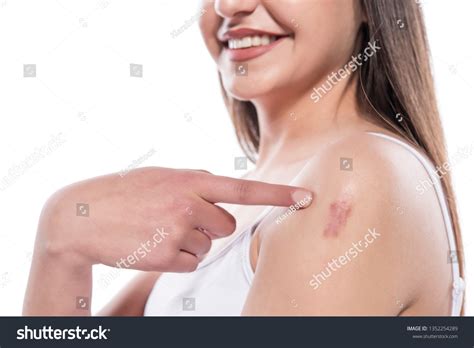 Woman Showing Surgery Scar Scars Removal Stock Photo 1352254289 ...