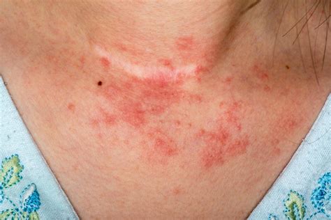 Eczema Rash Circle at Julia Carson blog