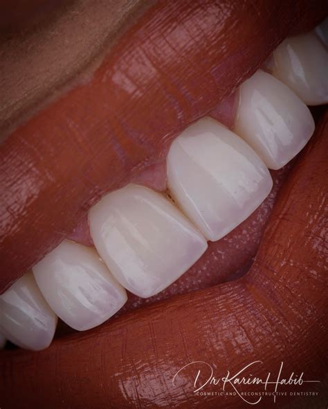 Composite Veneers Sydney | Dental Bonding Sydney - Dentist Ryde
