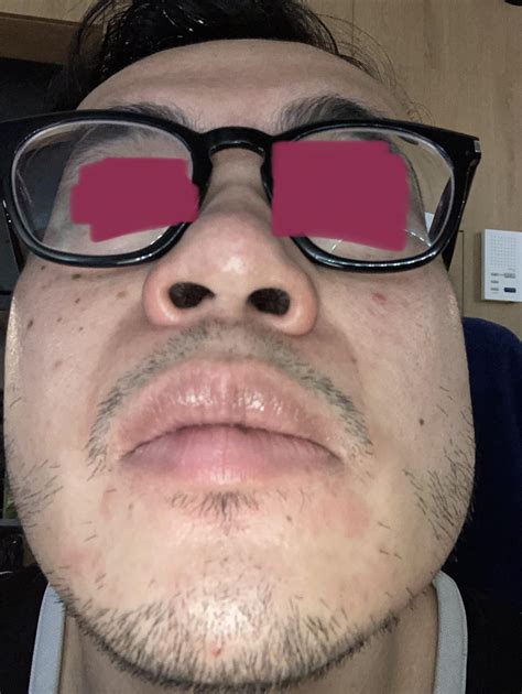 Discoloration around my mouth - is this irritation from tret? : r/tretinoin