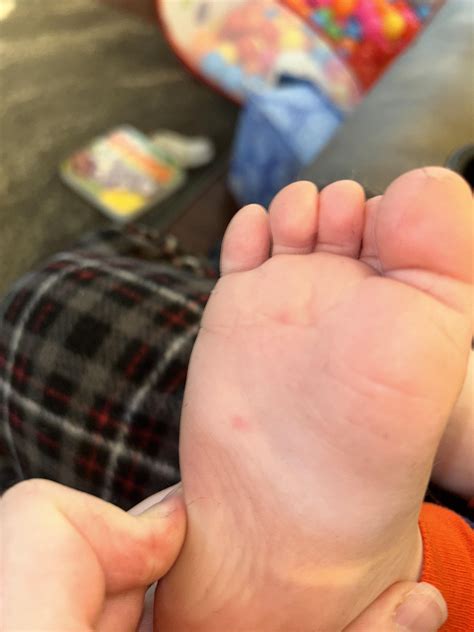 Does this look like the start of hand foot mouth? : r/medical_advice