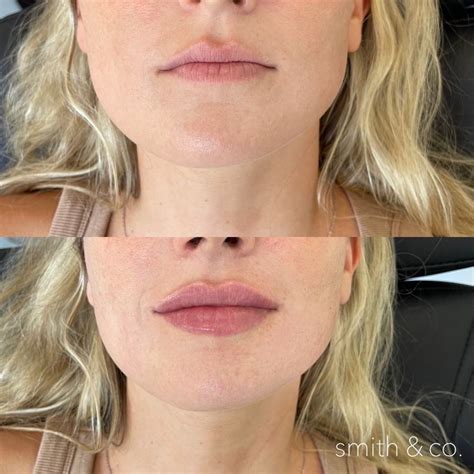 Natural lip fillers | Natural lips, Lip fillers, Lips inspiration