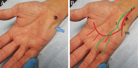 Teaching NeuroImage: Palmaris Brevis Sign | Neurology