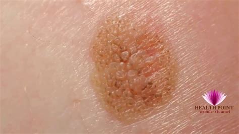 Melanoma Skin Cancer Symptoms