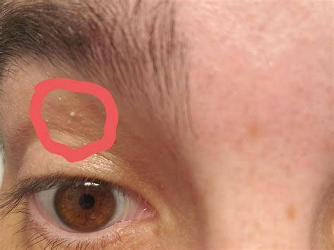 Bump(s) on/above eyelid : r/DermatologyQuestions