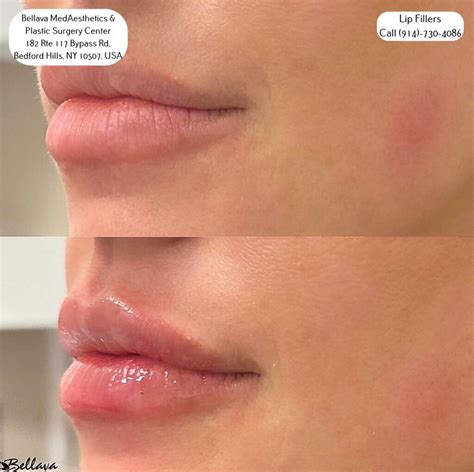 Juvederm Lip Filler: The Secret to Luscious, Irresistible Lips